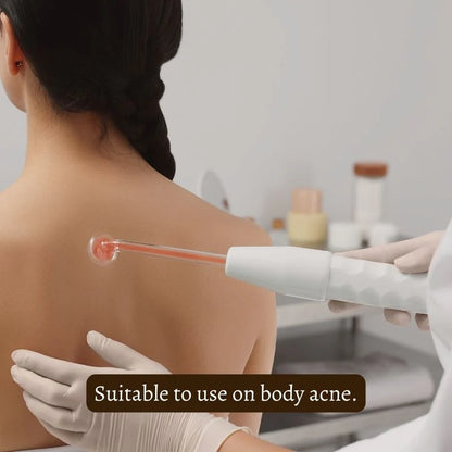 Nuderma Hochfrequenztherapie | Akne bekämpfen und zukünftige Ausbrüche verhindern